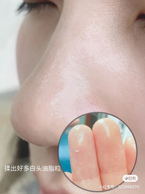 粉刺林清除黑頭粉刺2021清潔