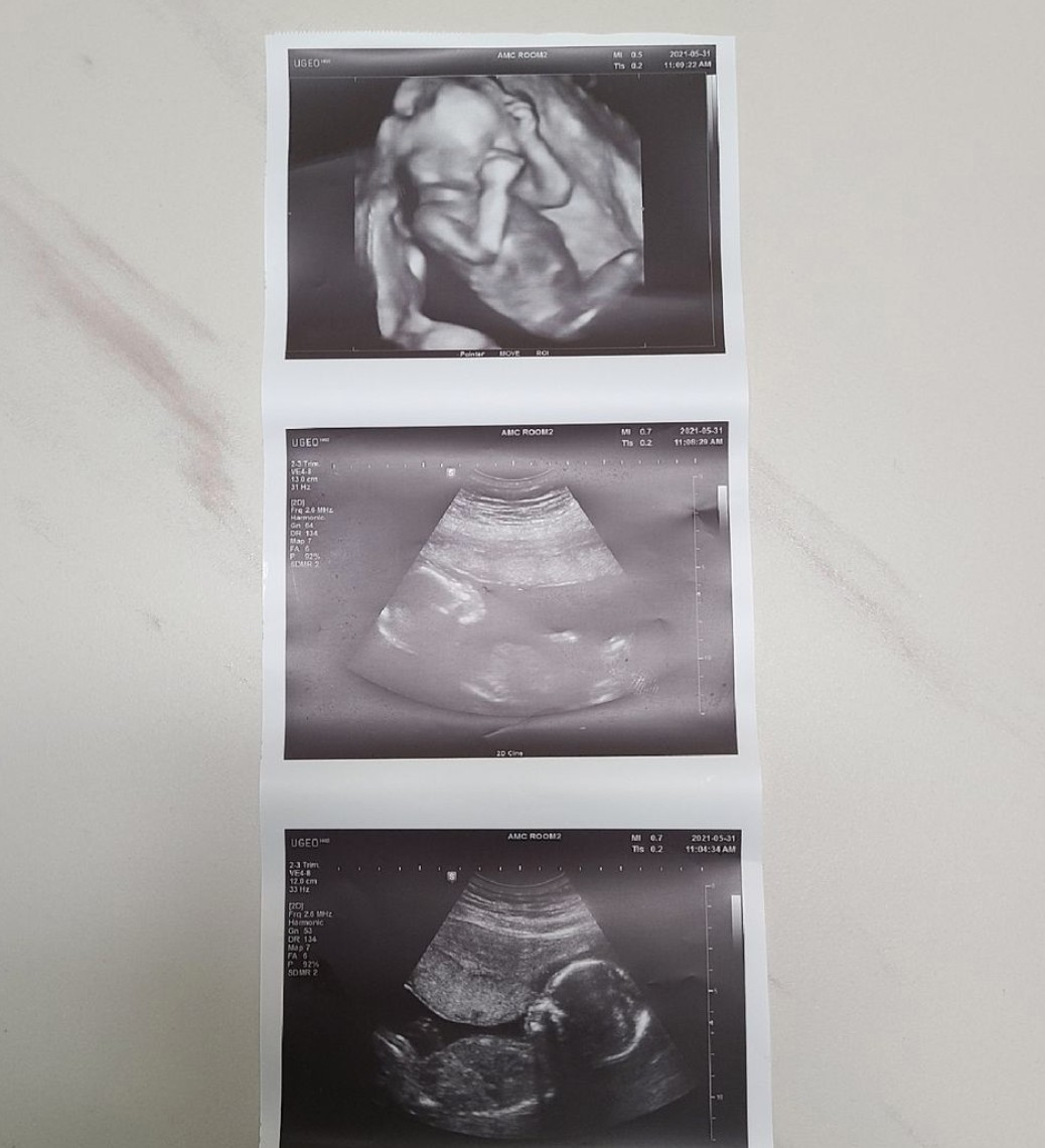 黃信英分享超音波照，感動表示「寶寶都健康」！引數萬網友祝福