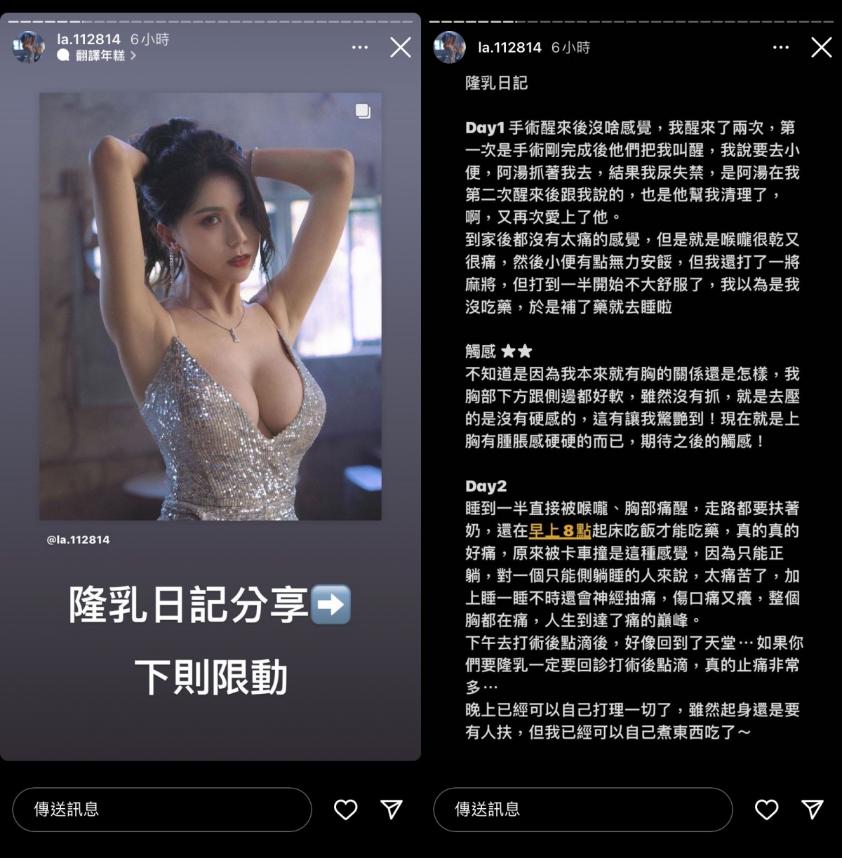 蕾菈於限動分享「隆乳日記」,內容提及術後的復原過程、每日狀況與觸感等