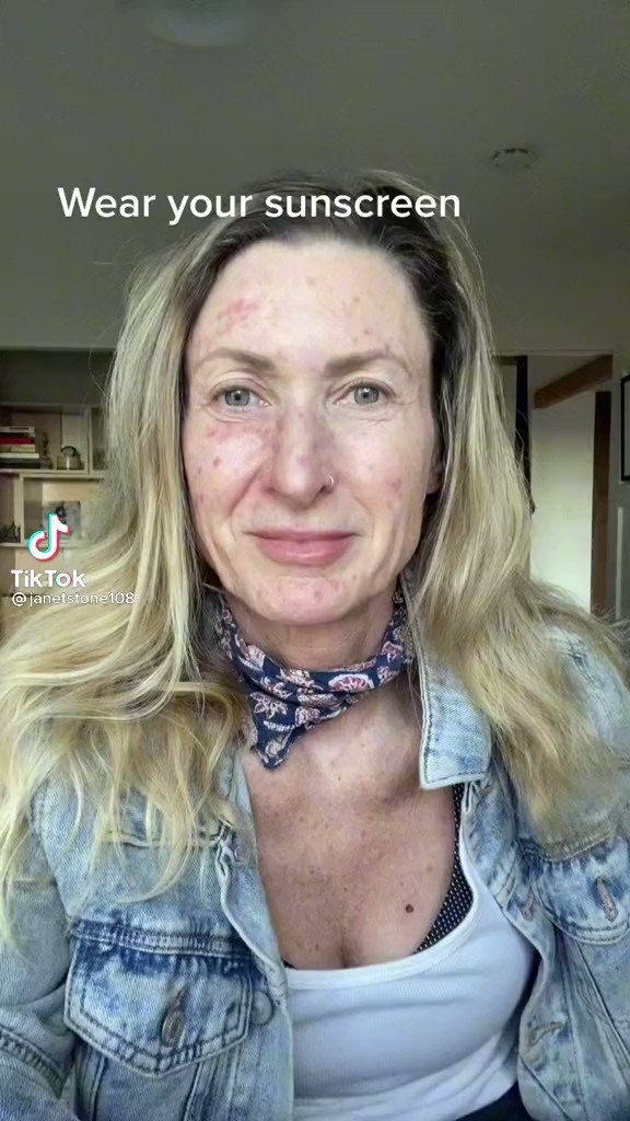 網友以過來人身分勸大家一定要防曬