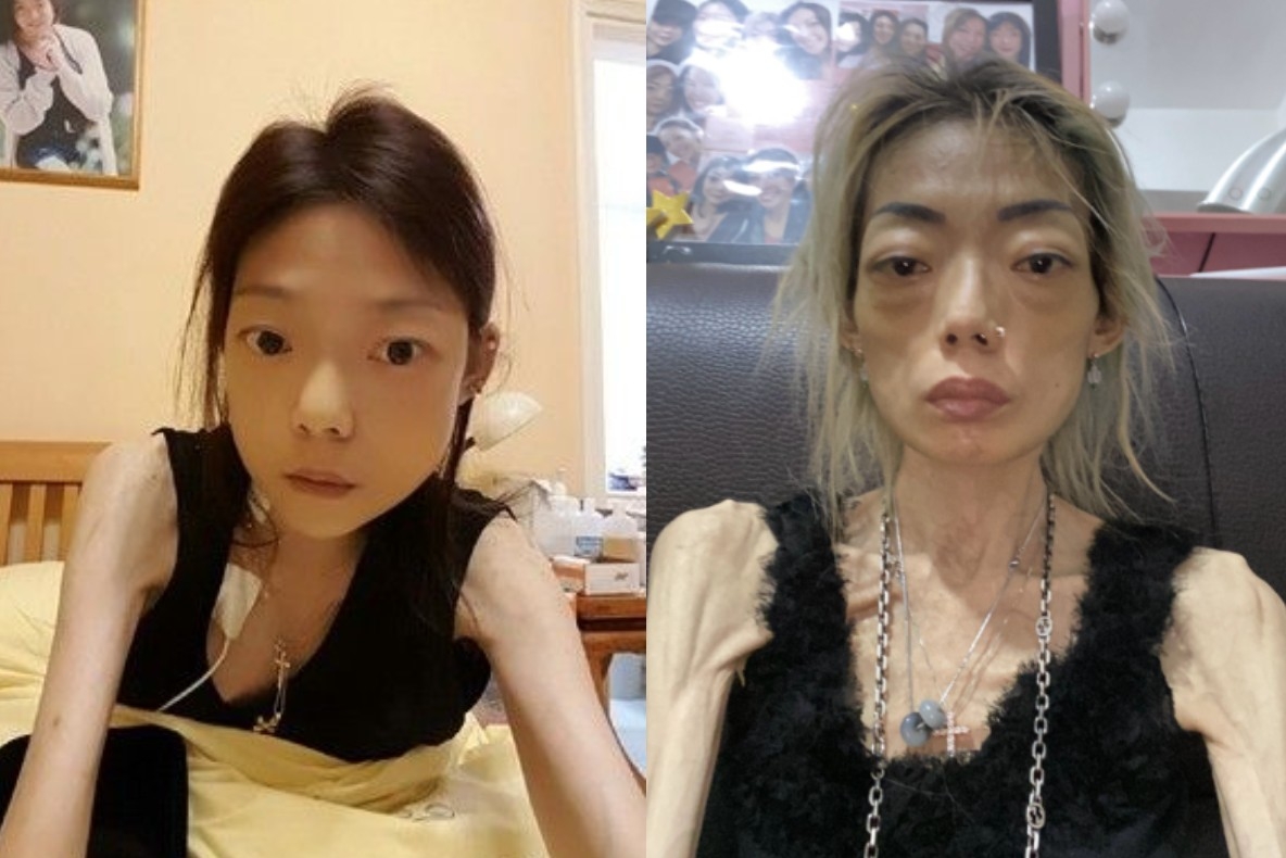 伍智恆罹患胃病後暴瘦。