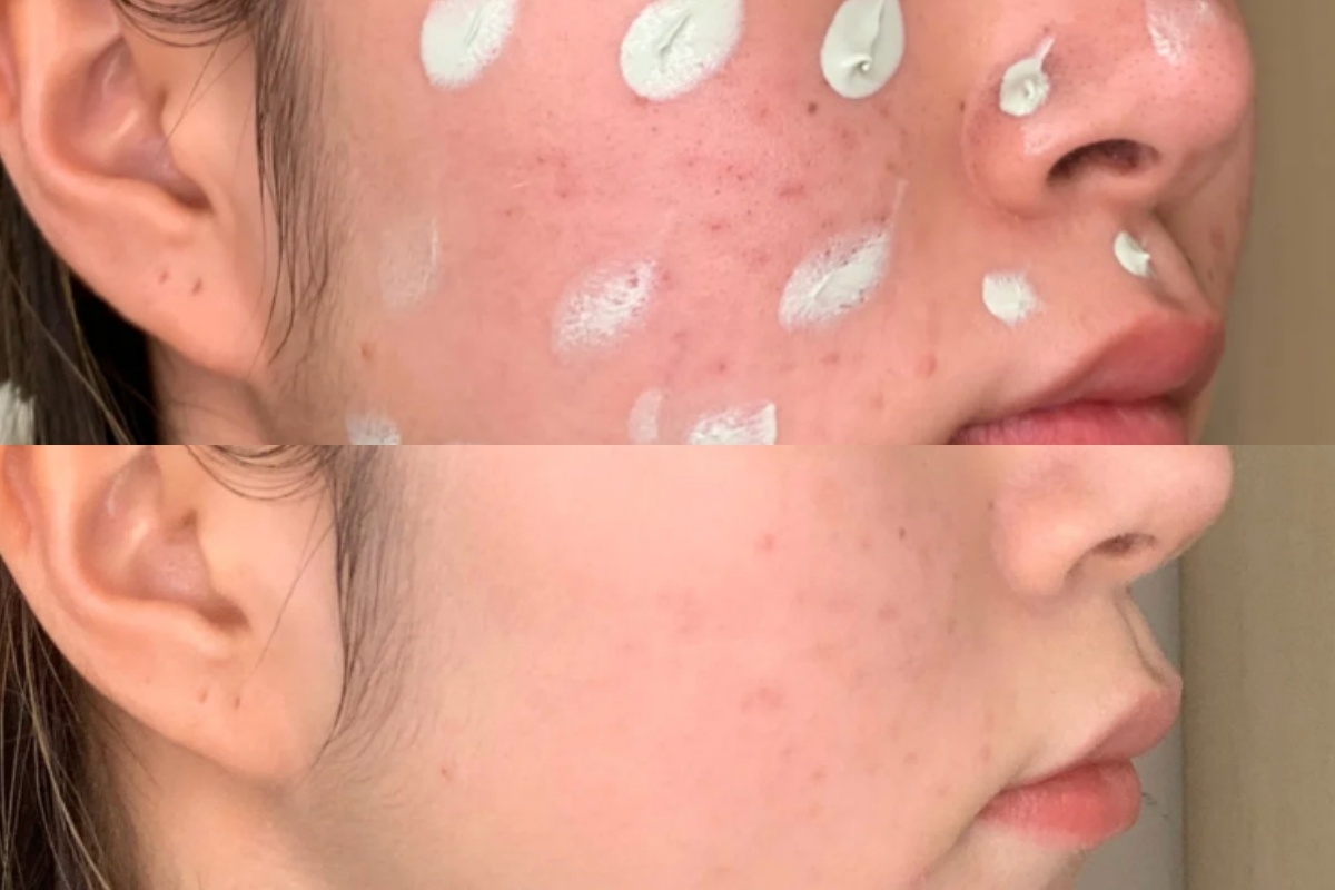 #大面積痘痘遮瑕方法