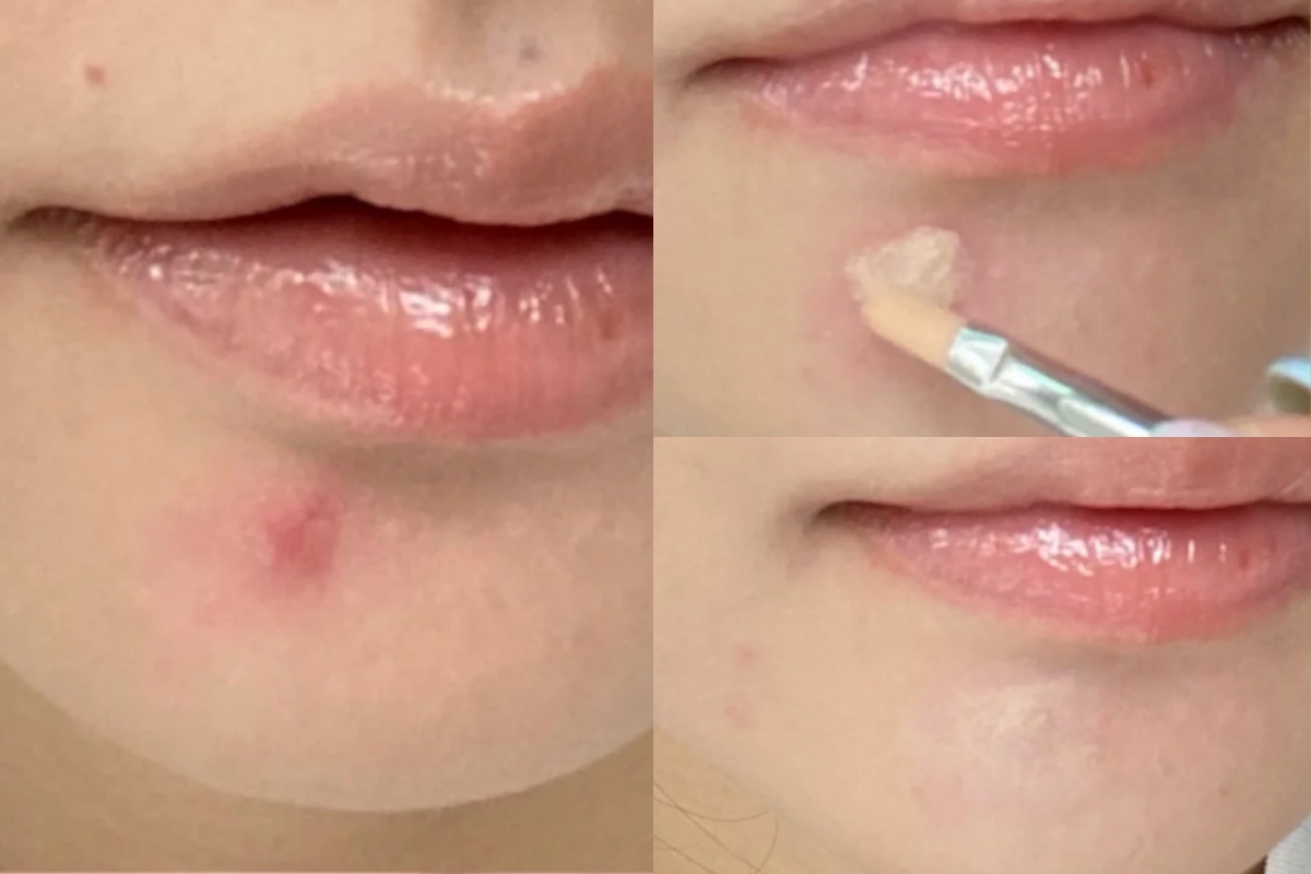 #紅腫痘痘遮瑕方法