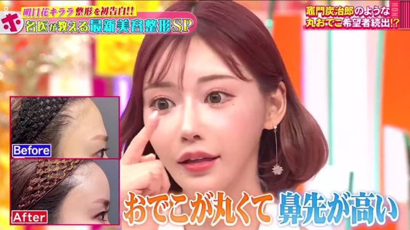 明日花綺羅眼下有打針