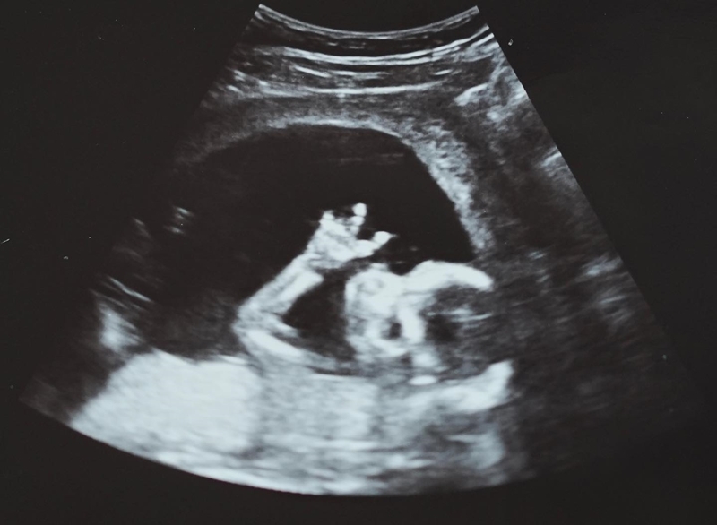 瘦子同月再曝老婆懷孕喜訊