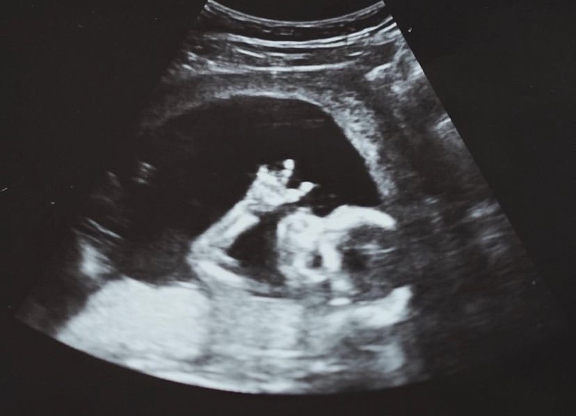 瘦子的寶寶超音波