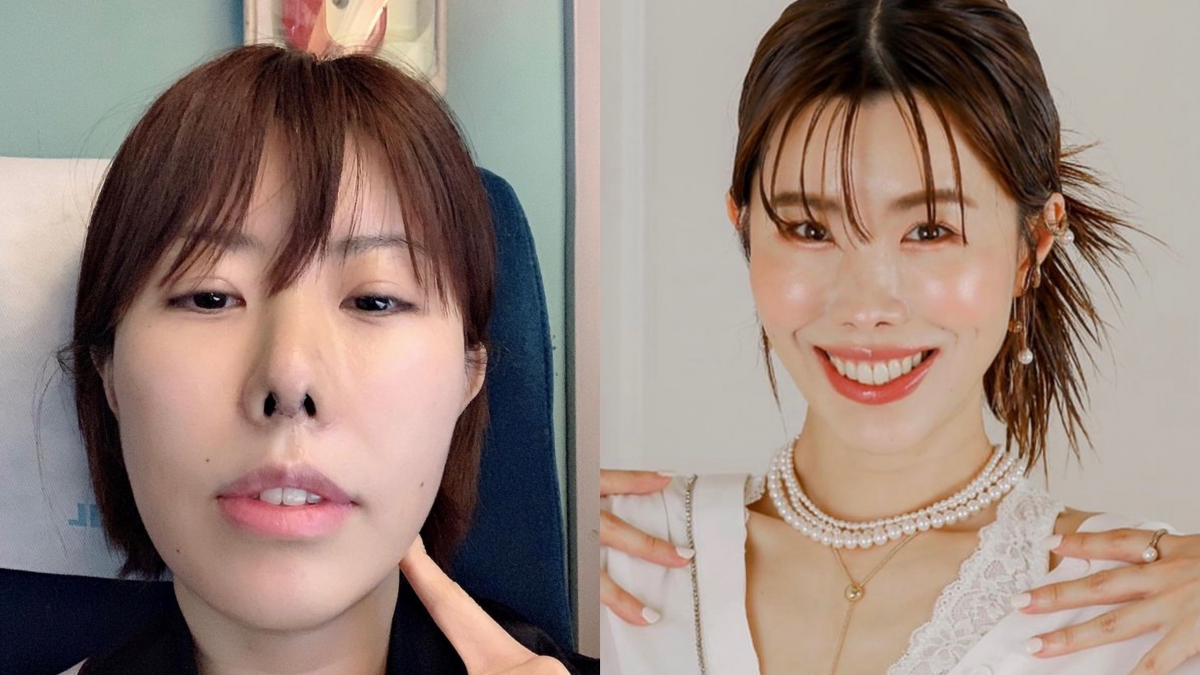 金老佛爺最近成功將失敗的鼻子整回好看的樣子