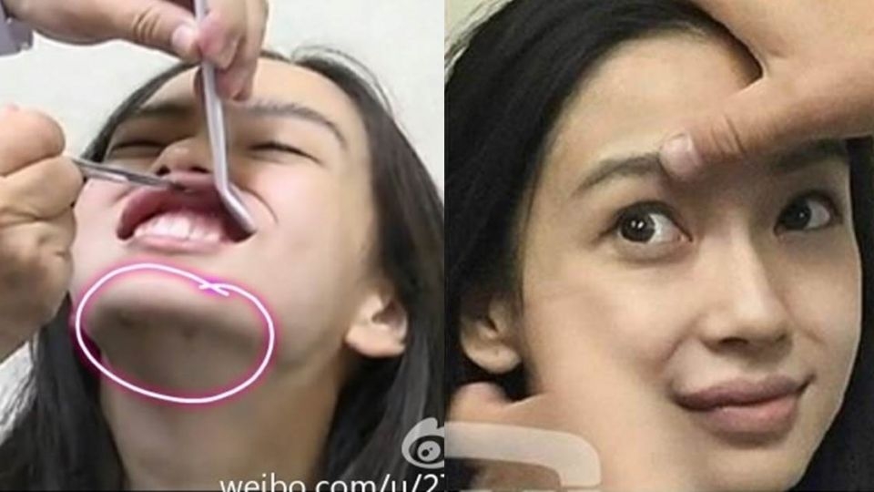 Baby曾去找醫美醫師自清