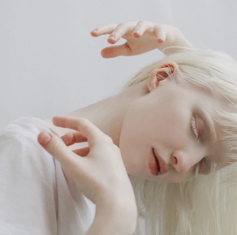 患白化症的她全身都是白色的