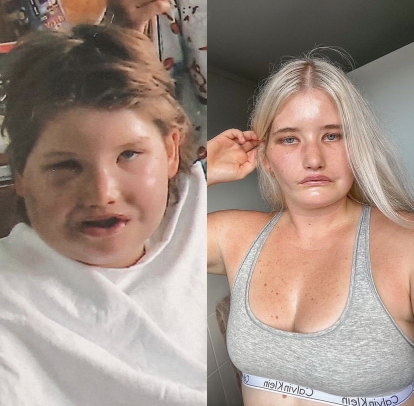 手術後她更遇上人生低潮