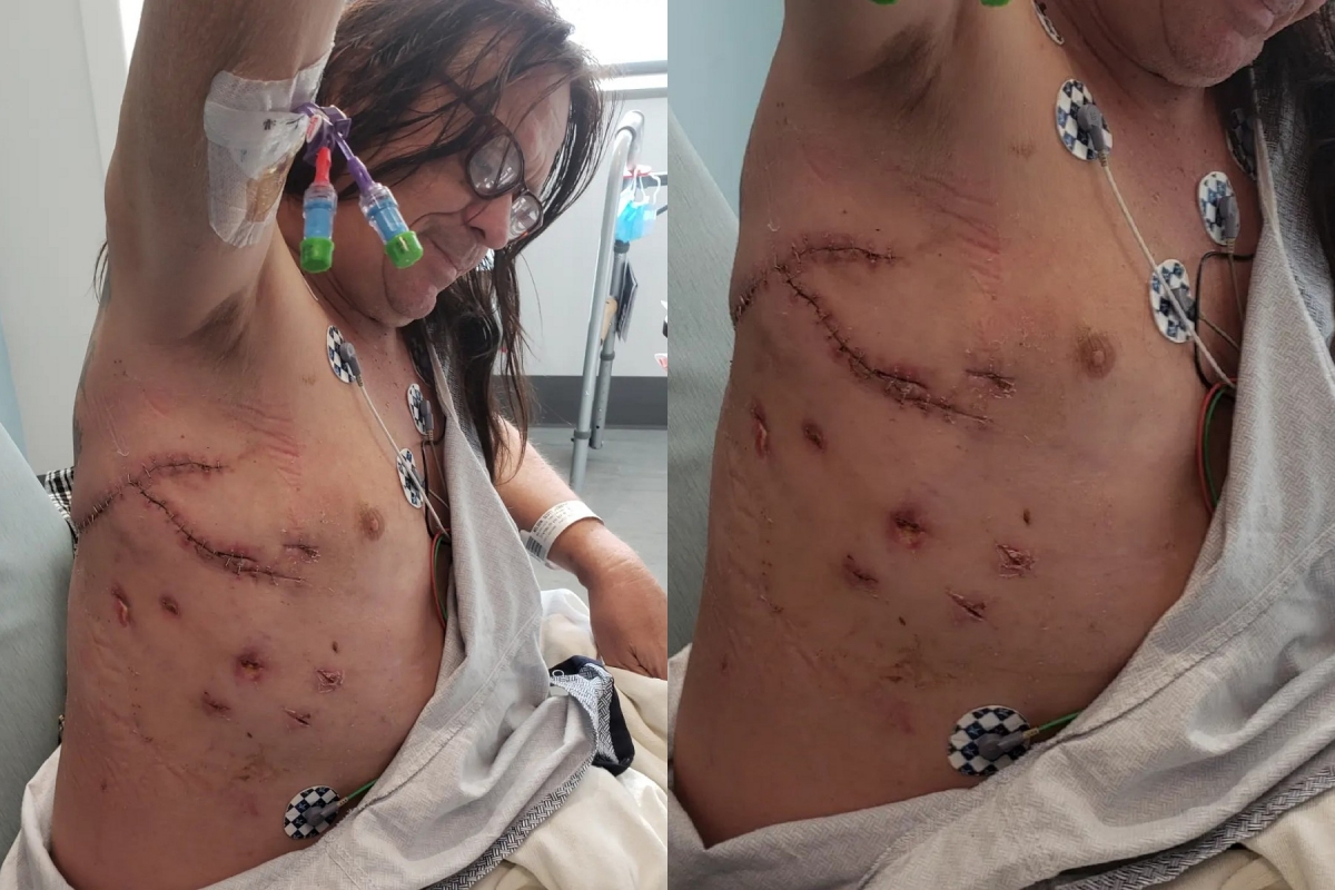 Scott Nelson展示他身上積年累月的許多挫傷、這些傷口和縫線也真實地證明了他的紮實技藝。