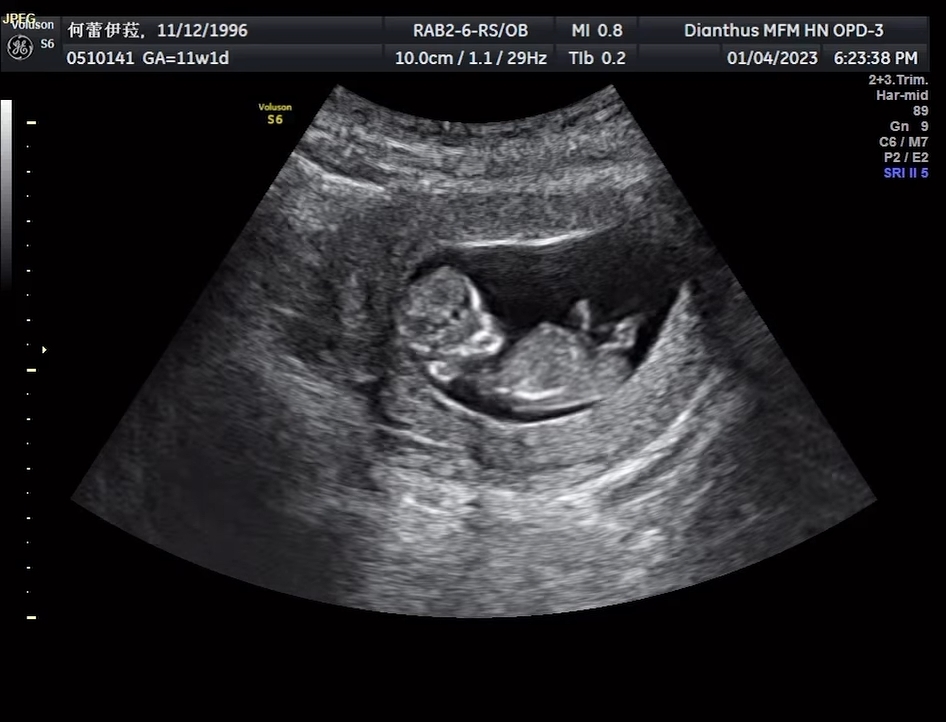 蕾菈在IG分享寶寶的超音波照片。