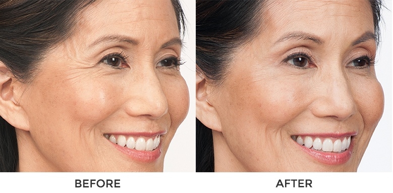 小資醫美療程推薦3：肉毒桿菌素注射