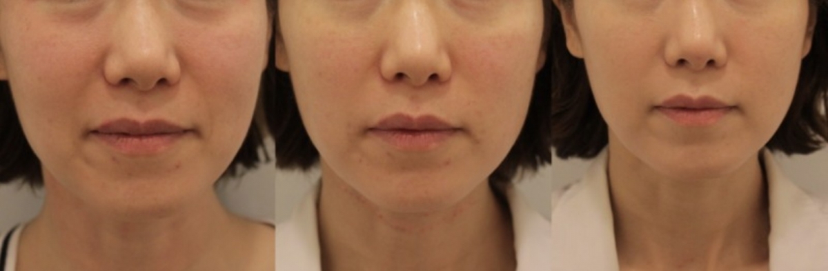 小資醫美療程推薦4：玻尿酸填充拉提