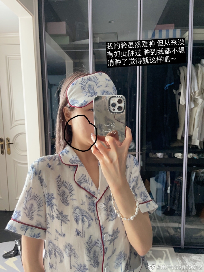 確診期間出現臉部腫脹情況