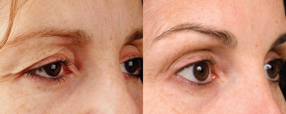 小資醫美療程推薦5：鳳凰碧眼電波