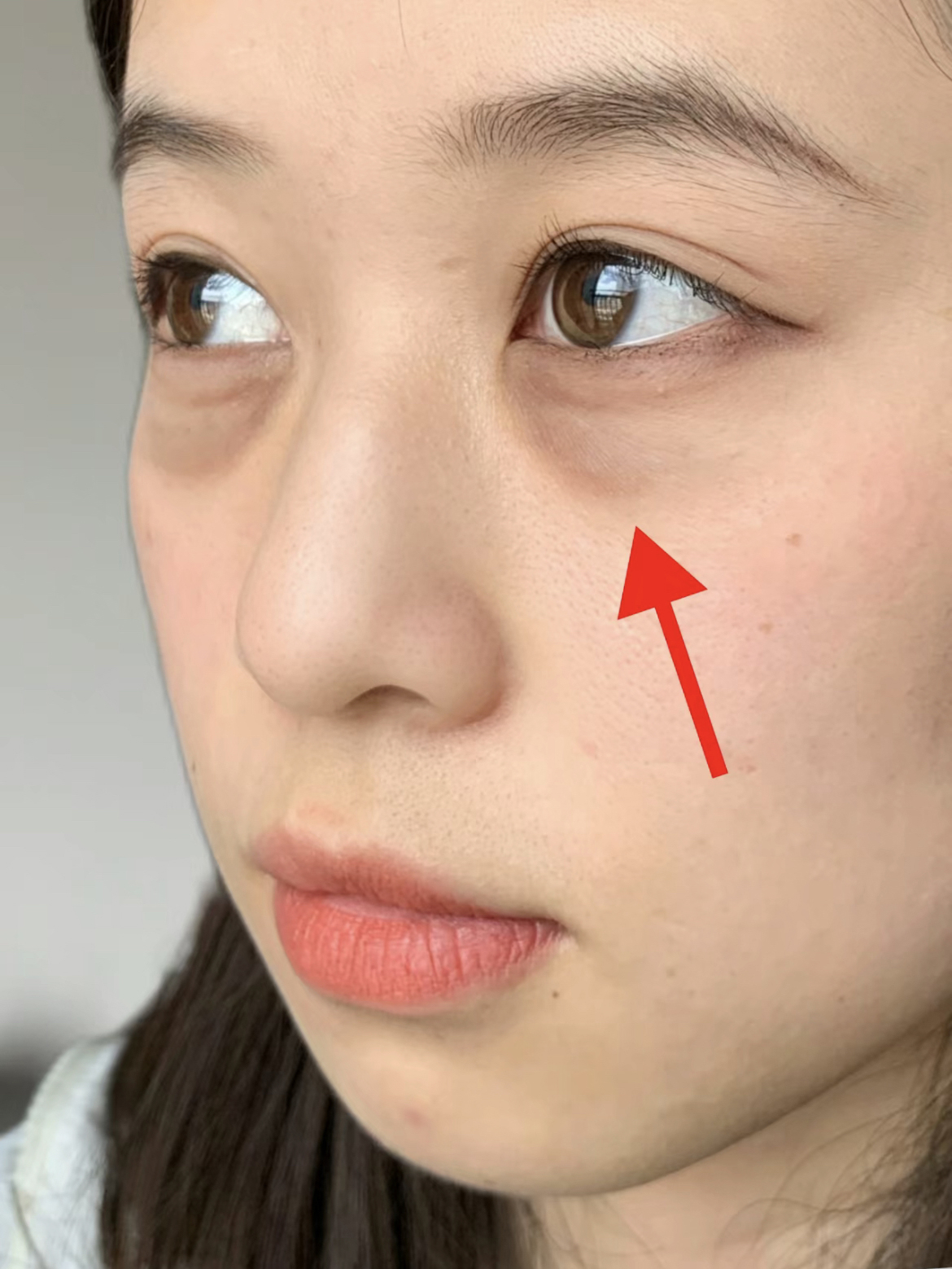 黑眼圈、眼袋以及淚溝都是常見的眼周問題