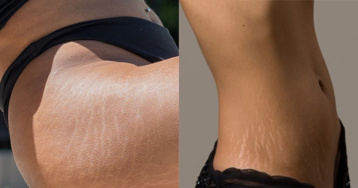 生長紋為橫向波浪形，肥胖紋為細長豎狀