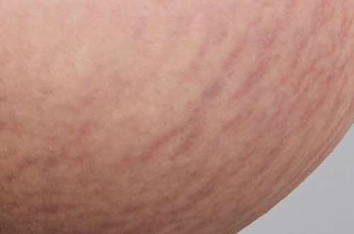 肥胖紋中期為淡粉色