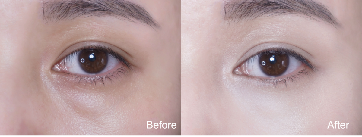 Before:淚溝明顯;After:面部平整度提升