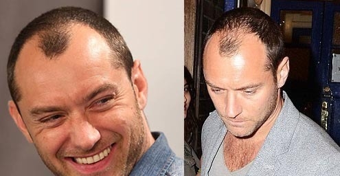 裘德洛被外媒指出禿頭危機