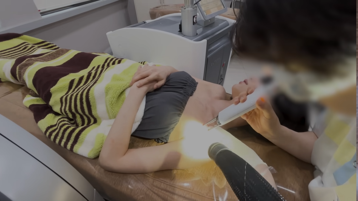 NANA去除肩膀刺青