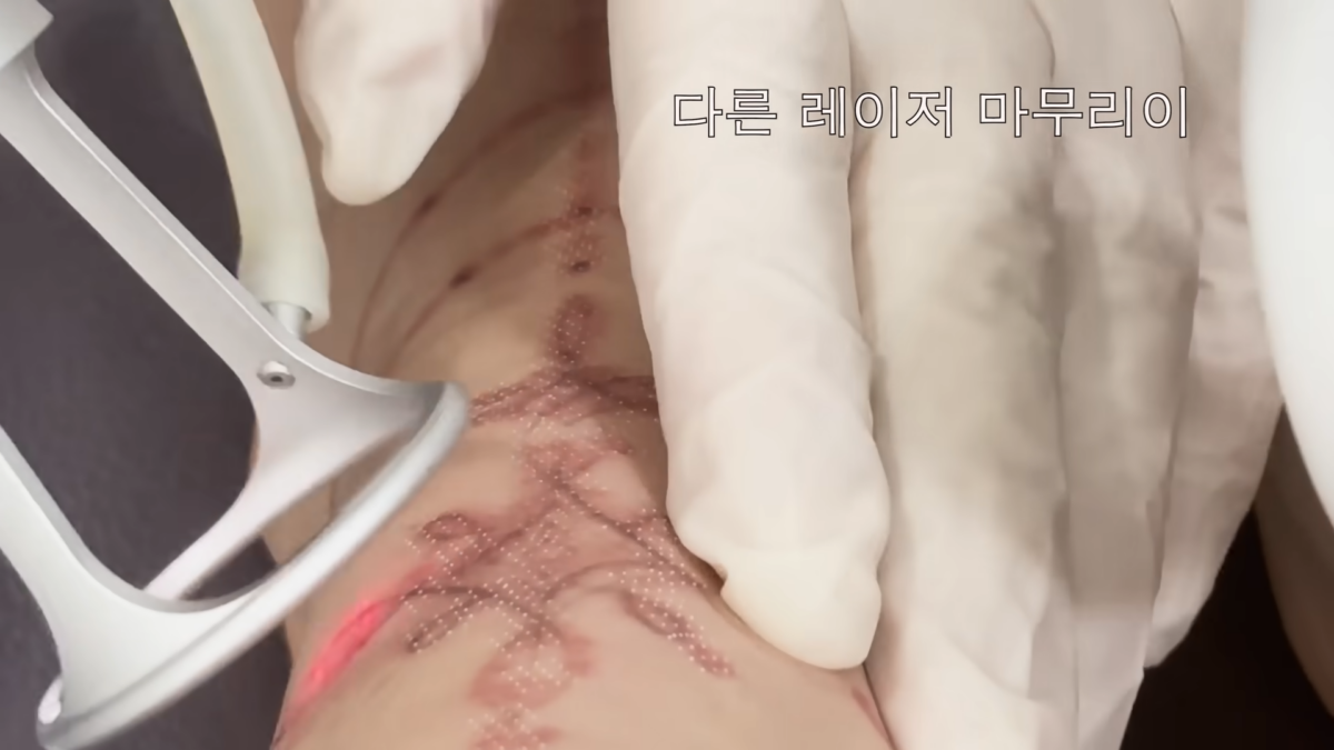 NANA耗時去除紋身