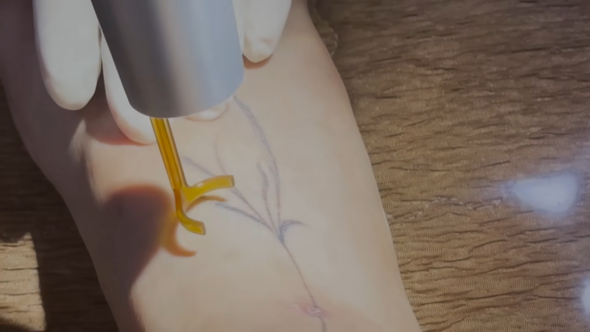 NANA去除腳步刺青