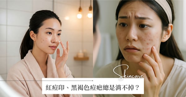 為什麼痘印總是消不掉?紅痘印、黑褐色痘疤分別是什麼,加碼「淨痘保養」擦養出素顏美肌!
