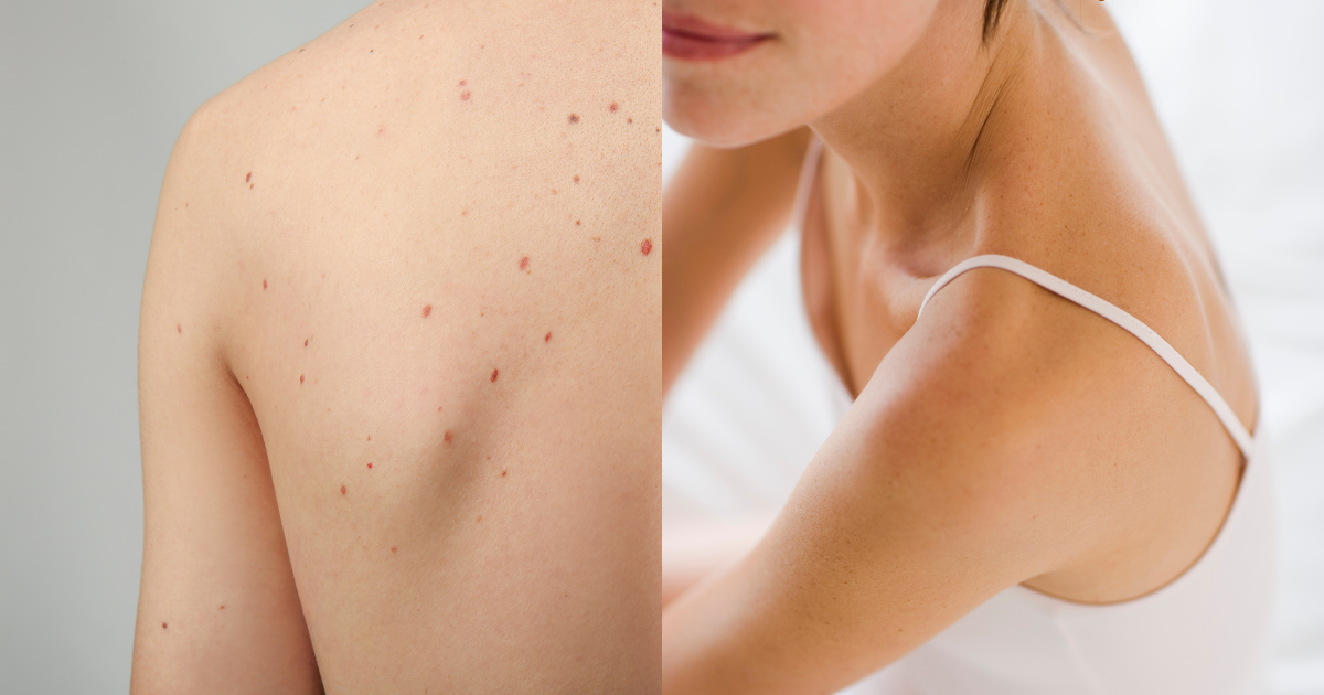 夏日膚肌膚問題03：夏日背痘來攪局