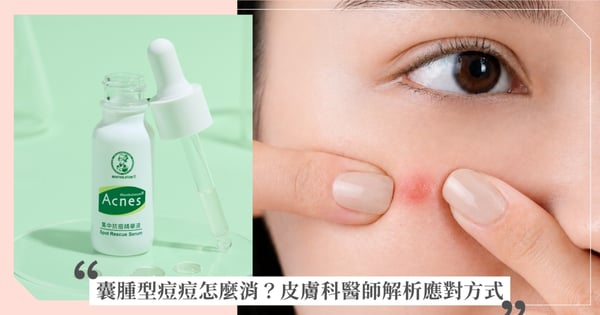 囊腫型痘痘怎麼消？沒有白頭、又紅又腫，硬擠還超痛，皮膚科醫師解析48 小時急救方法