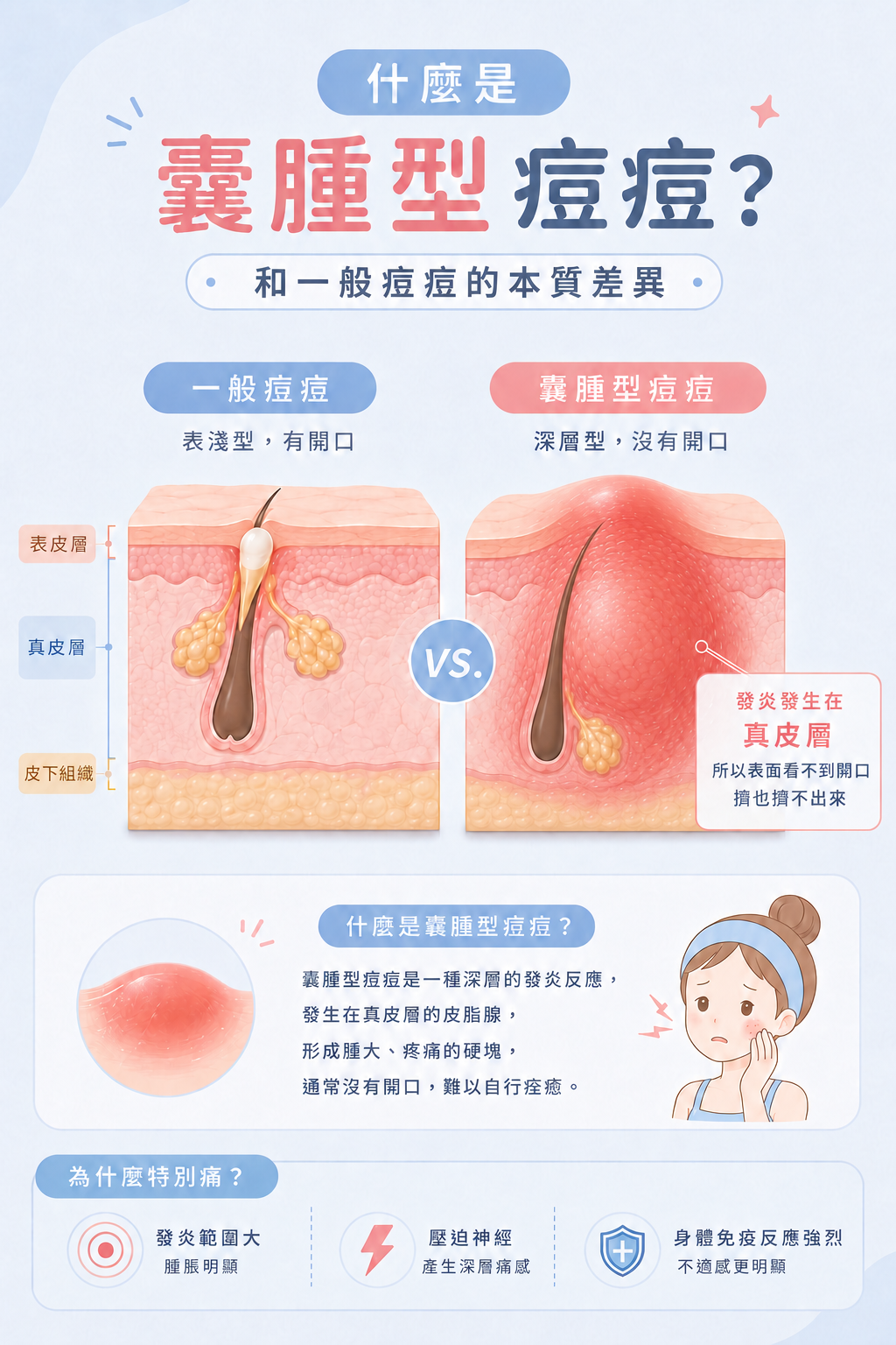 什麼是囊腫型痘痘？跟一般痘痘有什麼不同